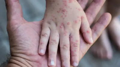 Alert Campak Australia Barat, Indonesia Perlu Waspada